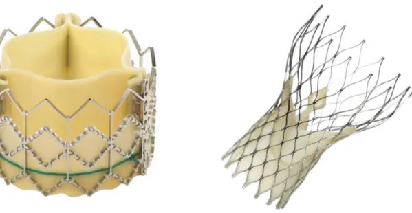 Figure  5.  Transcatheter  aortic  valve  implantation  using  the  Edwards  Sapien  XT  aortic  bioprosthesis  (transfemoral  and  transapical  cases,  left  picture)  and  the  CoreValve  Revalving  System  (only  transfemoral  cases,  right  picture)