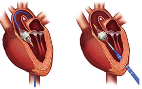 Figure 6. Transcatheter aortic valve implantation using the transfemoral (left picture) and  the transapical (right picture) access  route