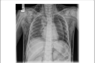 Figure 1: Urgent chest imaging studies revealed left-sided PTX and pneumomediastinum.  Neck  and  chest  subcutan  emphysema  was visible.