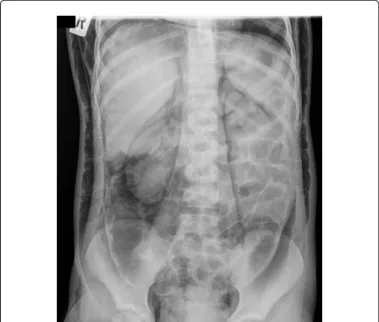 Figure 3: 1 cm wide perforation of the transverse colon was found.