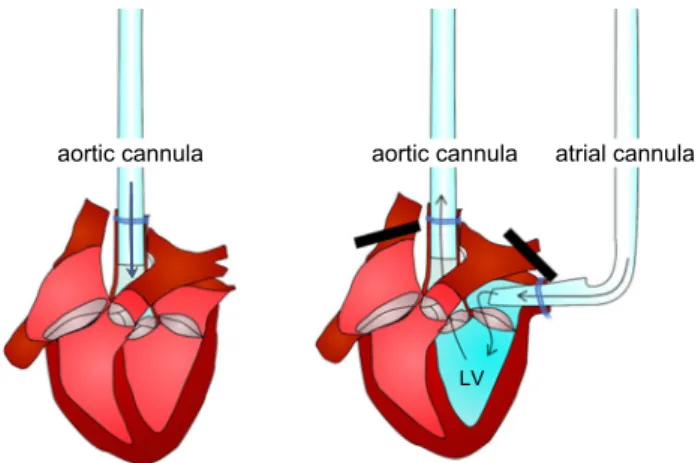 Fig. 8    In the Langendorff configuration, buffer from the aortic can‑