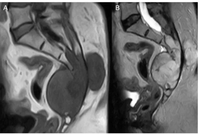 Figure 5 Sacral chordoma, sagittal MRI images A. T1, B. T2 sequence 