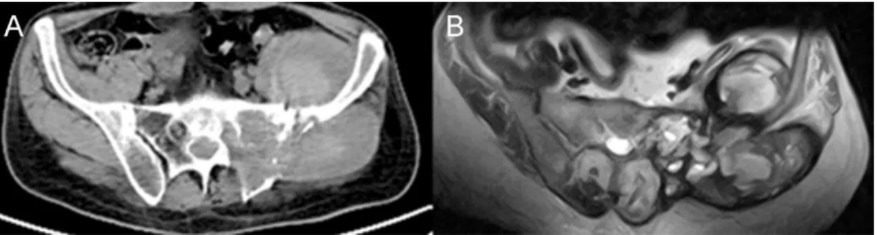 Figure 6 Sacral osteosarcoma: A. axial CT image, B. axial MRI image 