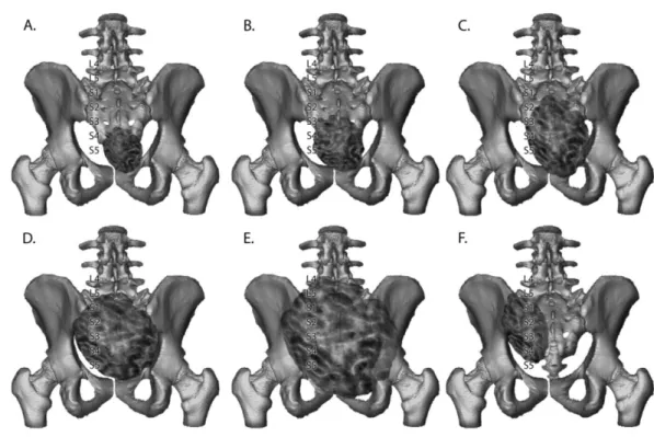 Figure  9  Categorization  of  sacral  resections  after  Fourney  et  al.  [27];  A.  Low sacral  amputation - the sacrifice of S4 nerve roots B