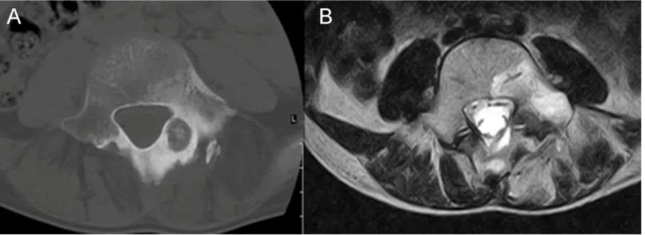 Figure 2 Osteoid osteoma of the posterior elements of the spine, A. axial CT image, B