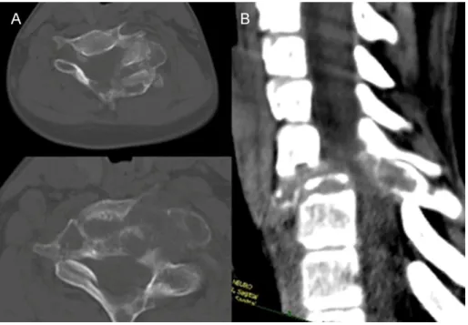 Figure  4  Radiological  appearance  of  an  ABC  secondary  to  cervical  osteoblastoma  (CVII) A