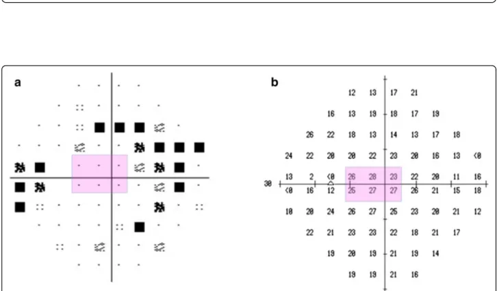 Fig. 2 Visual field of the left eye. Pattern deviation plot (a) and threshold plot (b) of the central 30° visual field (Humphrey Field Analyzer, Swedish Interactive Threshold Algorithm) show superior and inferior Bjerrum scotomas corresponding to the super