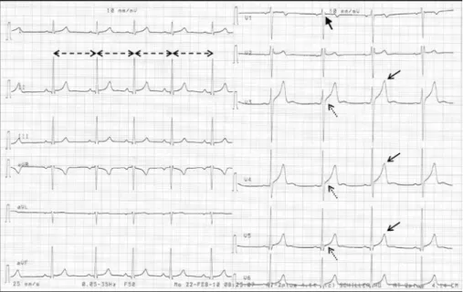 Fig. 2. A characteristic athletic ECG of a 23 years old elite male rower. Sinus bradycardia  