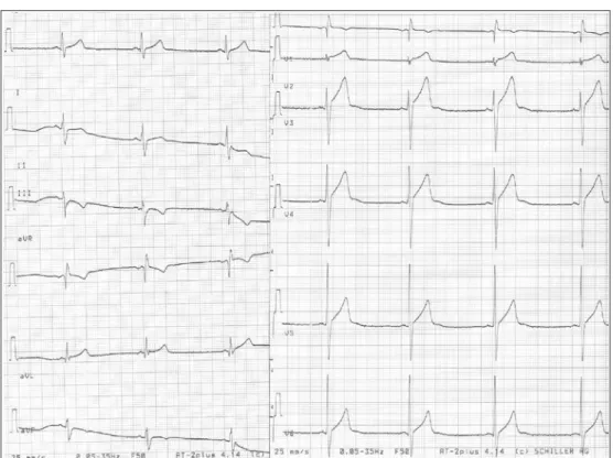 Fig. 4. Left ventricular hypertrophy considered pathological in an asymptomatic 31 years old elite male rower