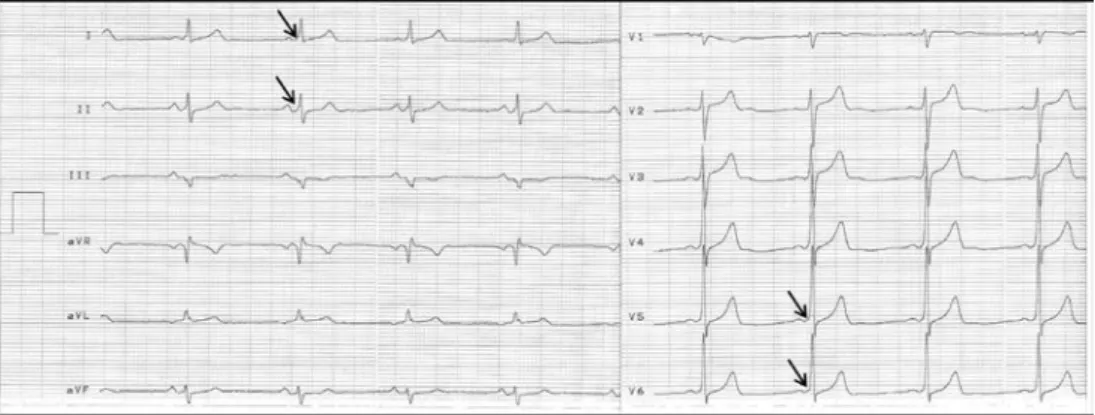 Fig. 5. Sinus bradycardia (mean heart rate: 58/min). Delta waves appearing in inferior and lateral leads (arrows),  causing slightly widened QRS komplexes (110 msec) and shortened AV-conduction (PQ: 100 msec) on the ECG 