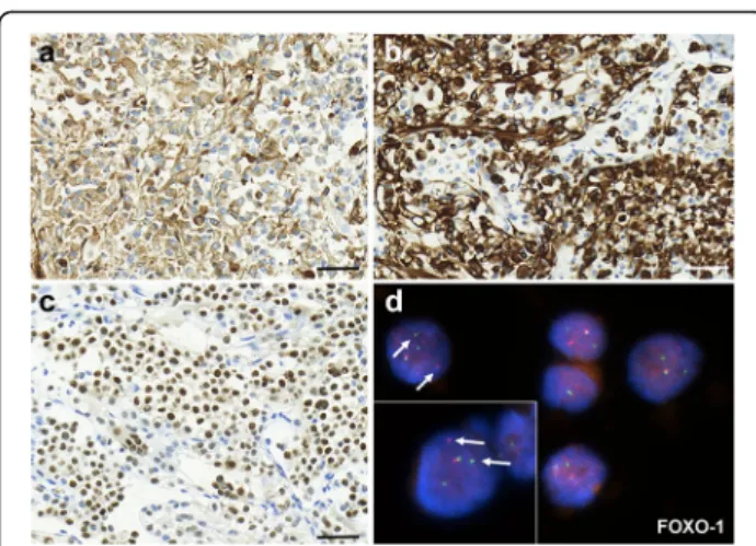 Fig. 2 Immunohistochemical and molecular characterization of tumor cells. a Tumor cells show diffuse vimentin positivity, as well as diffuse and strong cytoplasmic and nuclear labelling could be observed with myogenic markers desmin and Myf-4, respectively