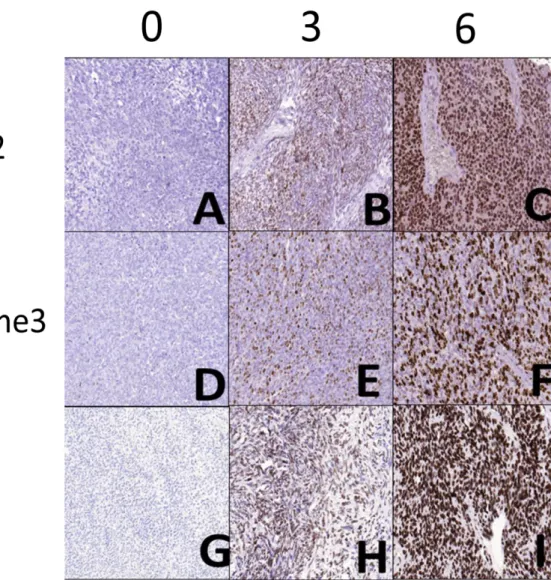 Figure 9. Photomicrographs representing the scores 0, 3, and 6 for EZH2 (A, B and C), H3K27me3 (D, E  and F), and Ki-67 (G, H and I) immunostaning