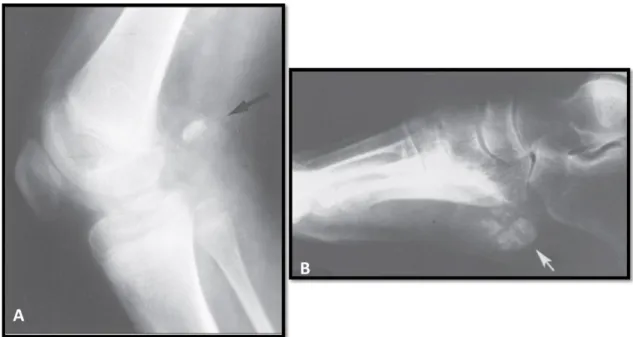 Figure  1.  Synovial  sarcoma  originating  in  (A)  popliteal  fossa  and  (B)  plantar  region  with  calcification  [5]
