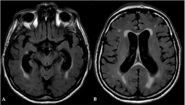 1. ábra Agyi MRI képe két különböző horizontális metszetben a diagnóziskor (FLAIR-szekvenciák)