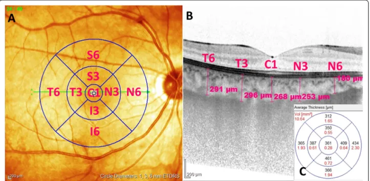 Figure 1 Measurement of choroidal and retinal thickness in ETDRS fields. 1A. Demonstrates the 1, 3 and 6 mm diameter ETDRS circles superimposed on the pseudocolor infrared image