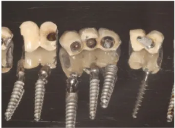 Figure 1: Implants were removed due to peri-implantitis.