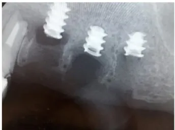 Figure 2. Implant fracture.