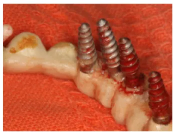 Figure 4: Seriously advanced peri-implantitis.