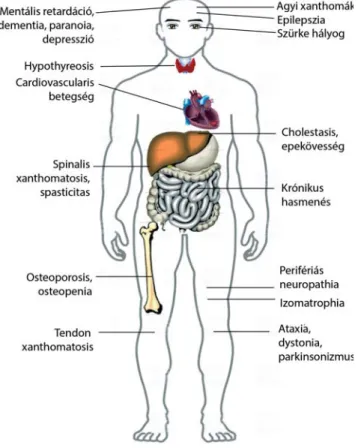 3. ábra A cerebrotendinosus xanthomatosis jellegzetes tünetei