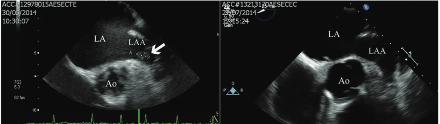 1. ábra A beteg transoesophagealis echokardiográfiás képei. Bal oldalon a rivaroxabanhatásban detektált fülcsethrombus látható (nyíl), jobb oldalon a két  hónapnyi dabigatran-antikoagulációt követő állapot látható, ahol a fülcse üres