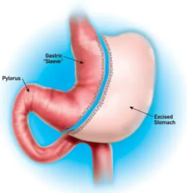 Kép 2: Sleeve gastrectomia. Forrás: www.drsharma.ca weboldal 
