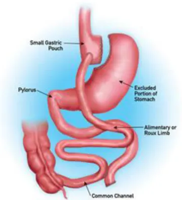 Kép 3: Roux-en-Y gastric bypass. Forrás: www.surgicalhealingarts.com weboldal 