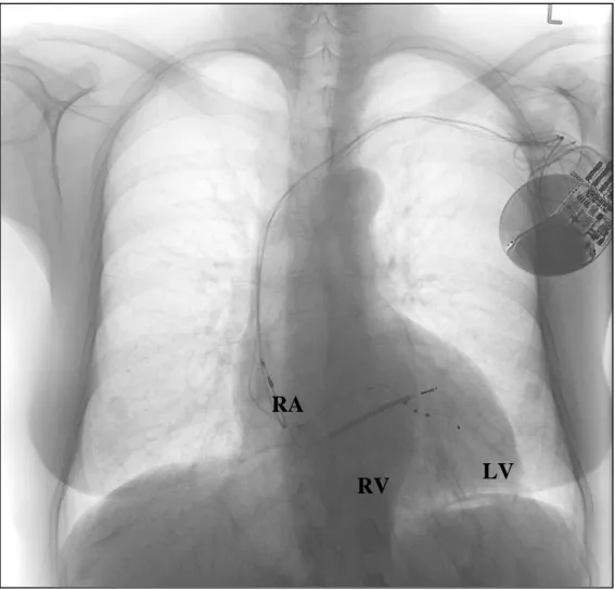 Figure  3.  Antero-posterior  X-ray  of  a  patient  with  a  CRT-D  system.  RA:  right  atrial,  bipolar  lead;  RV:  right  ventricular,  bipolar,  single-coil  ICD  lead;  LV:  left  ventricular,  quadripolar lead in a lateral side branch of the corona