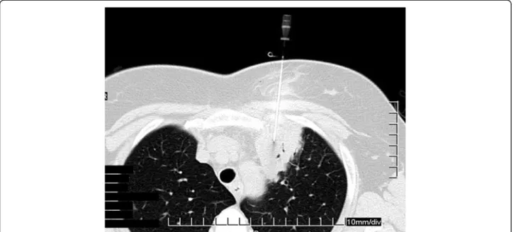 Figure 3 Computed tomography (CT) guided needle biopsy of the left upper lobe lesion.