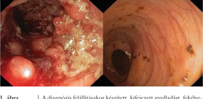 1. ábra A diagnózis felállításakor készített, kifejezett gyulladást, fekélye- fekélye-ket igazoló kolonoszkópos felvétel (bal oldal), és az autológ  haemopoeticus őssejt-transzplantációt követően végzett  kont-rollkolonoszkópos kép, amely makroszkóposan ép