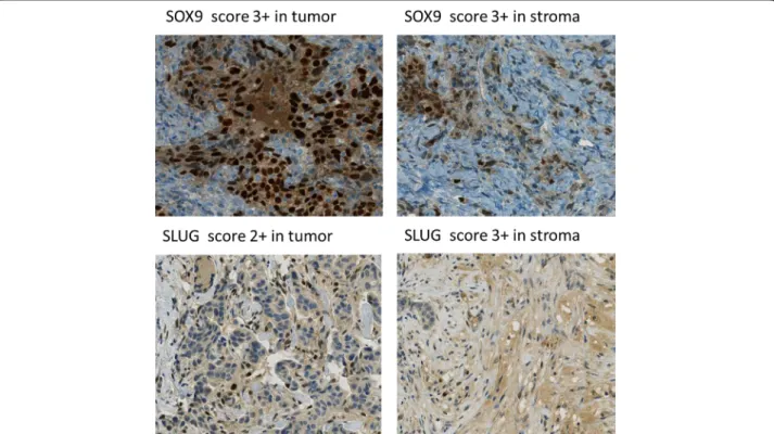 Figure 2 Immunohistochemical expression of Sox9 and Slug in tissue microarrays showed in tumor compared to the expression in stroma.