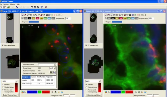 8. ábra. Az XY-FISH (bal oldal) és az ezután végzett CD45/CK kettős fluoreszcens festés  (jobb oldal) kiértékelése Mirax Viewer digitális mikroszkóppal