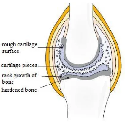 Figure 2 Schematic illustration of rheumatic joint caused by wear (Röder, 2010) 