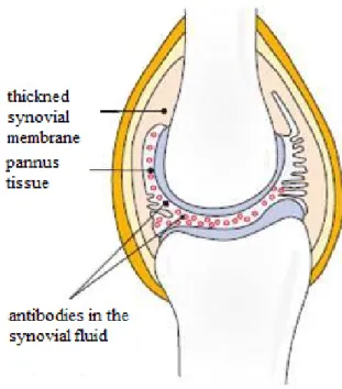 Figure 3 Schematic illustration of rheumatic joint caused by inflammation (Röder,  2010) 