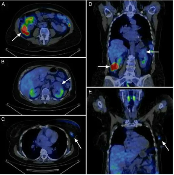 Figure 1: Abnormal FDG uptake in the three localisation according to the sagittal and coronal view of the PET-CT