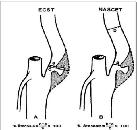 5. ábra - A diaméterre vonatkoztatott szűkület számítási módszerei az ECST és  NASCET studyban  - Forrás: Osborn AG (1999) Diagnostic Cerebral Angiography 26