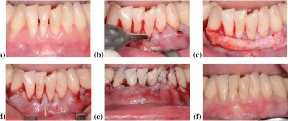 Fig. 7   MCAT with SCTG for treatment of multiple Miller class III defects. a Baseline b Tunneling c  Trimmed SCTG d SCTG in the tunnel, e suspended sutures f 2 years outcome