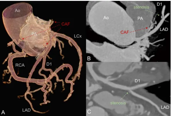 FIGURE 2.  Invasive coronary angiography and percutaneous coronary intervention. A shows the coronary artery fistula (red arrow)  originating from the first septal branch of the LAD