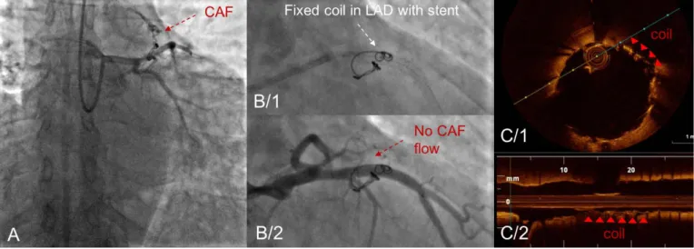 FIGURE 4.  Second coronary angiography due to reoccurrence of patients’ symptoms. A – Reopened coronary fistula (red arrow)