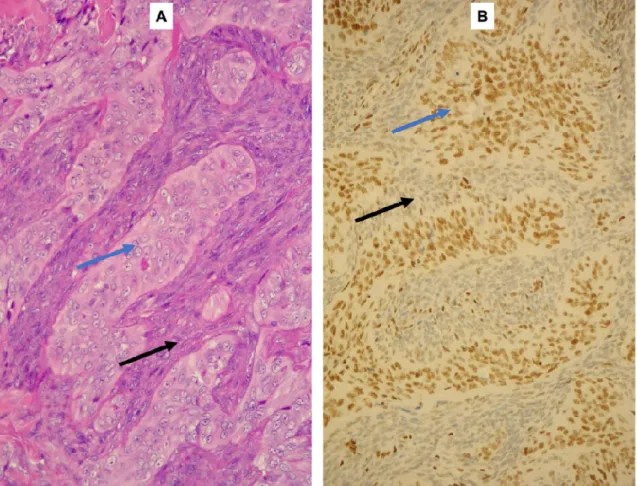 2. Ábra: Synovialis sarcoma jellegzetes immunhisztokémiai festődése TLE1  (B),  EMA  (C),  β-c