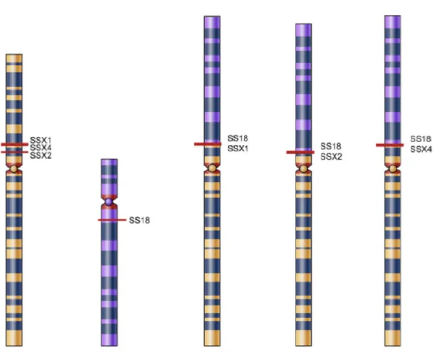 4. Ábra: A synovialis sarcoma jellemző transzlokációi. A bal oldali két kromoszóma az  intakt  X  (sárga)  és  18-as  (lila)  kromoszómákat  ábrázolja,  míg  a  jobb  oldali  három  a  kromoszómatörés  és  fúzió  utáni  SS18