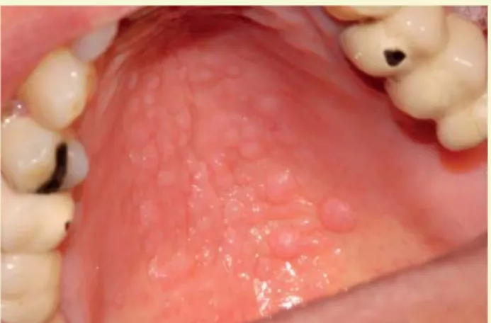 3. ábra: Krónikus candidiasis papilláris megjelenése a kemény száj- száj-padon