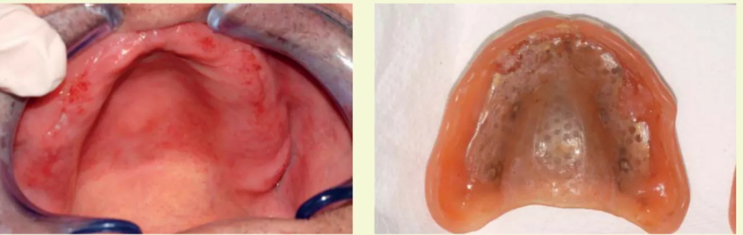 6. ábra: Fogsor-stomatitis. Az erythema lefutása pontosan követi a fogsor körvonalát