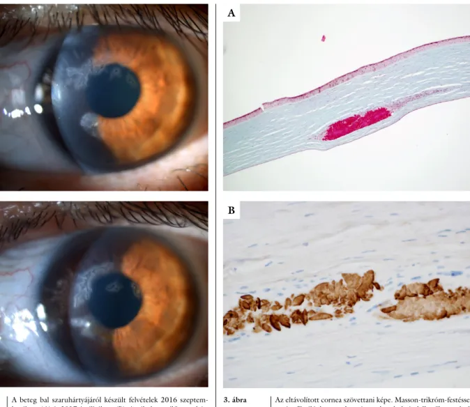2. ábra A beteg bal szaruhártyájáról készült felvételek 2016 szeptem- szeptem-berében (A) és 2017 áprilisában (B)