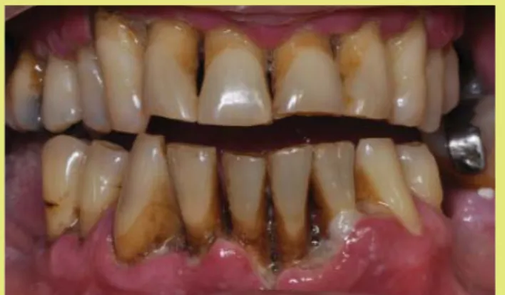 3. ábra: Nekrotizáló ulceratív parodontitis