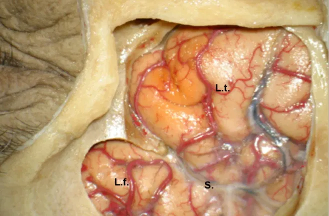 21. Ábra. 6. réteg. A felvétel a kemény agyhártya eltávolítása utáni helyzetet mutatja, amint  a frontális (L.f.) és a temporális lebeny (L.t.) részei megjelennek a Sylvius árokkal