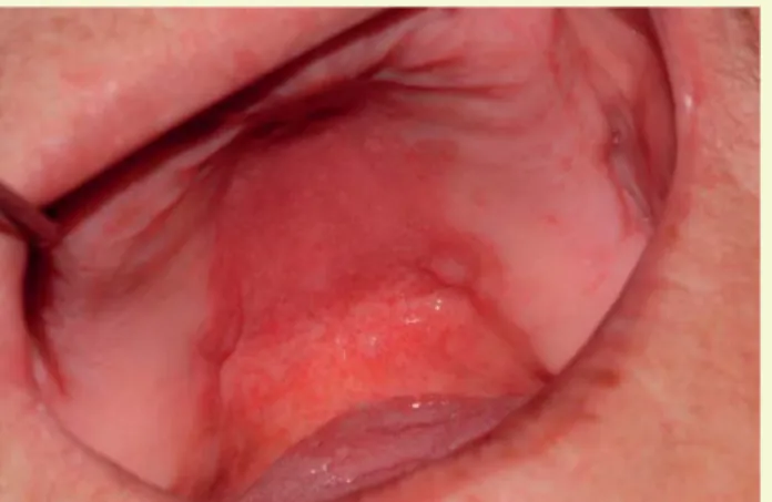 1. ábra: Krónikus erythemas candidiasis oralis corticosteroid- corticosteroid-tartalmú asztma elleni sprayt használó beteg szájpadlásán