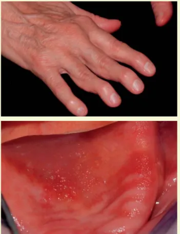 2. ábra: Álhártyás Candida-fertőzés biológiai terápiával kezelt RA-s  beteg szájpadlásán