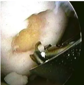 2. ábra. Abrasios arthroplastica artroszkópos műtéti képe 