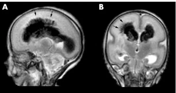 Figure  1.  MRI  image  showing  a  characteristic  injury  of  the  premature  brain,  germinal  matrix  -  intraventricular  hemorrhage  on  both  sides  with  parenchymal  involvement  on  the  right  (arrows)