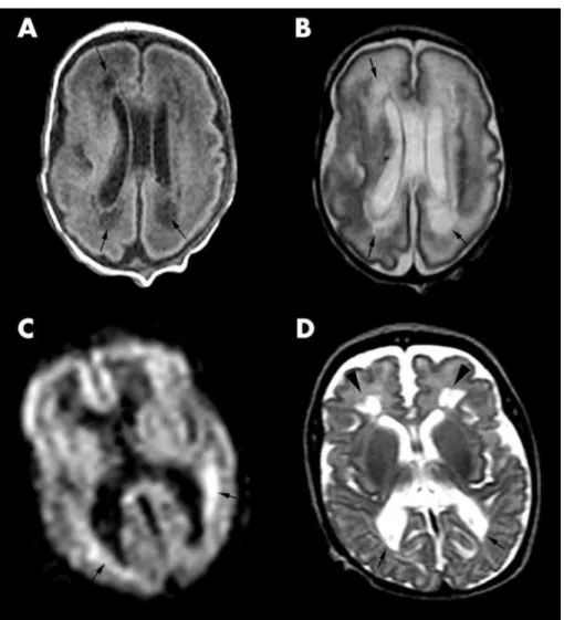 Figure 2. MRI image showing a characteristic form of injury of the premature brain,  periventricular  leukomalacia (PVL)